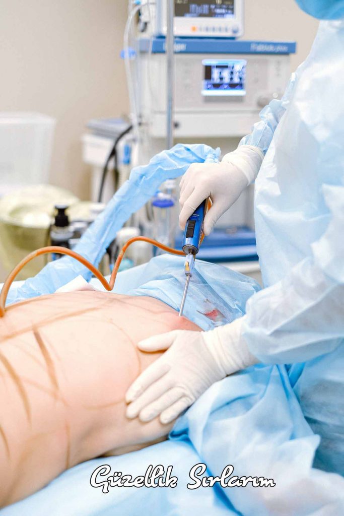 Liposuction Yöntemi