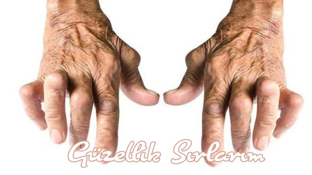 İltihaplı Romatizmanın Bitkisel Tedavisi