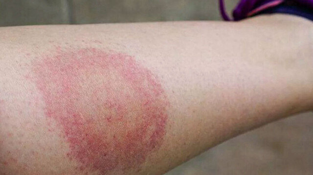 Lyme Hastalığı